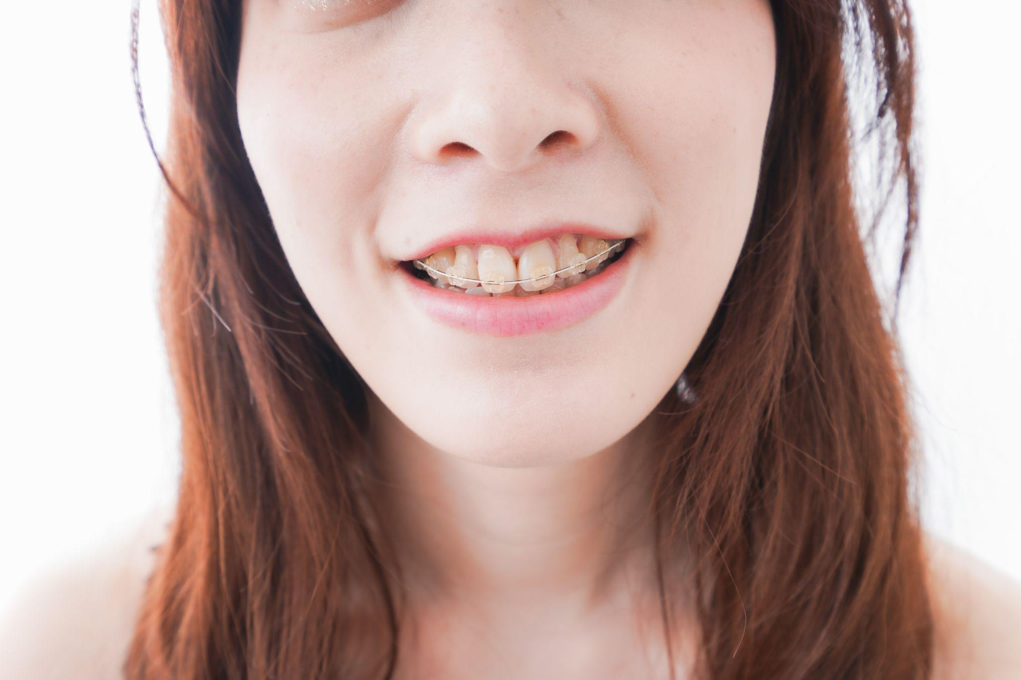 口ゴボがひどい場合の治療法とは？悪化する原因や放置のリスクを紹介