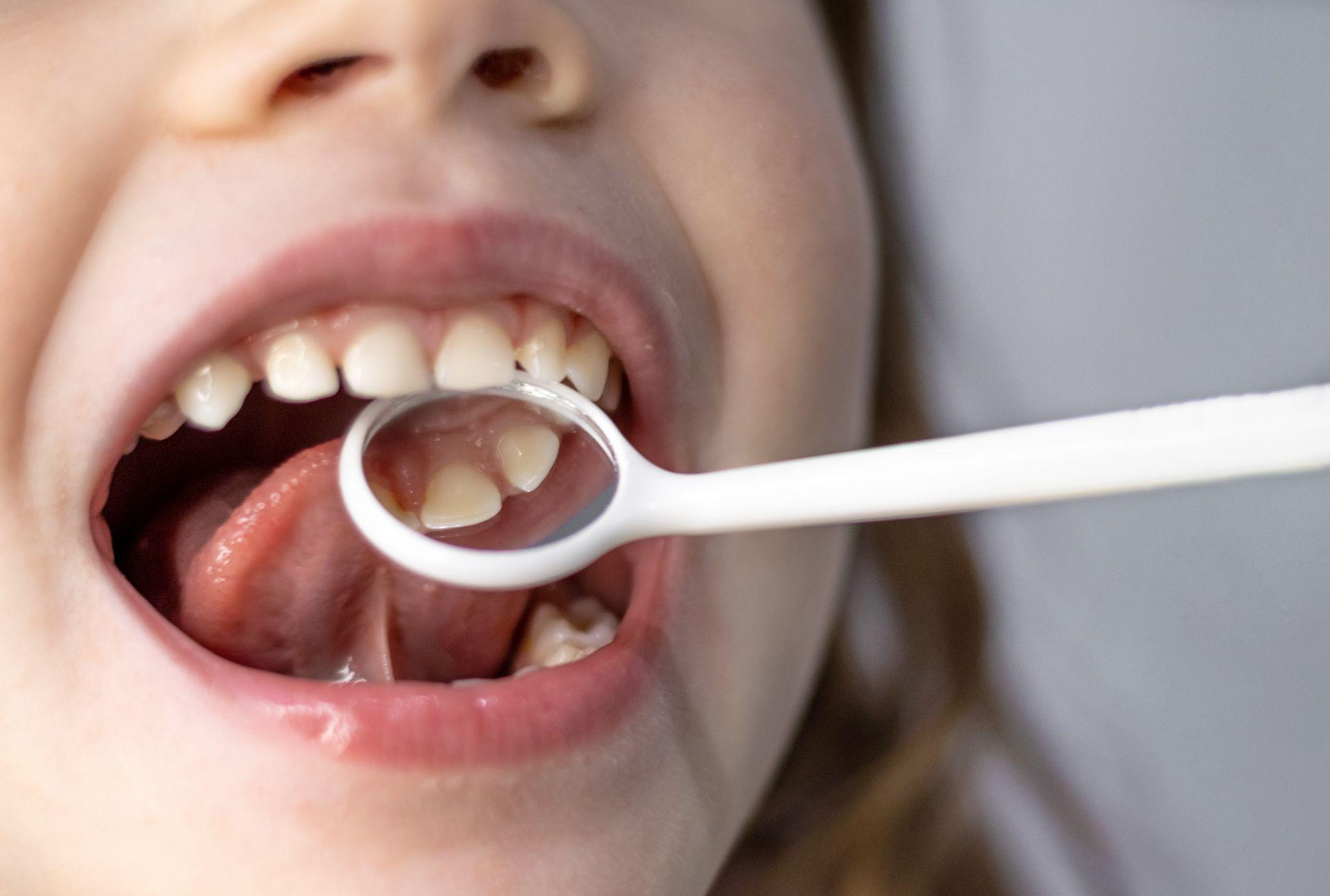 自然に治る子どもの歯並び