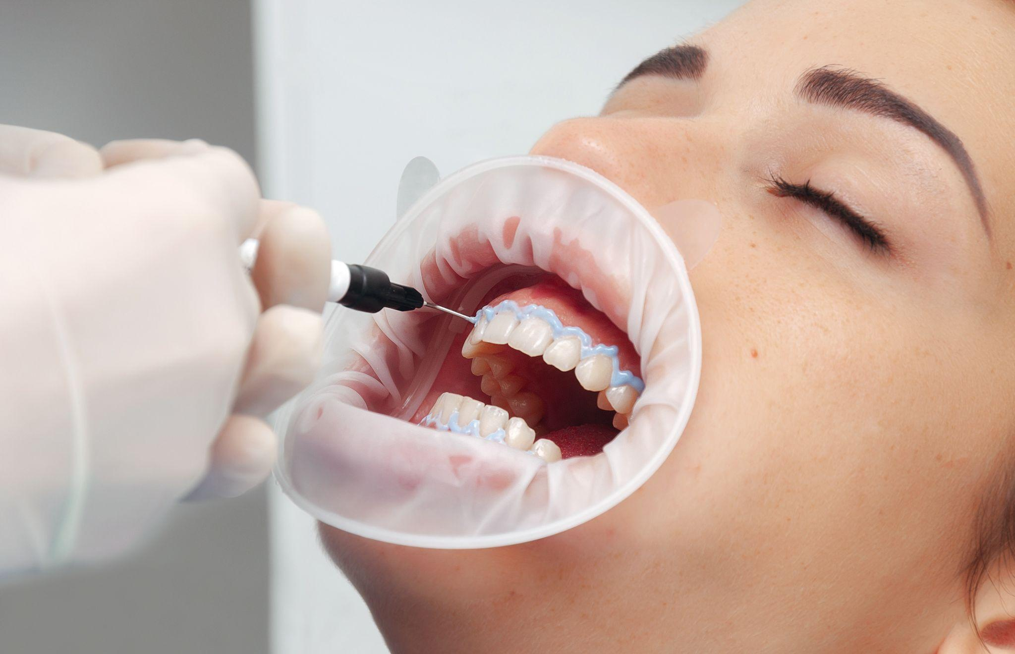 歯列矯正の前にホワイトニングを行うとどうなる？