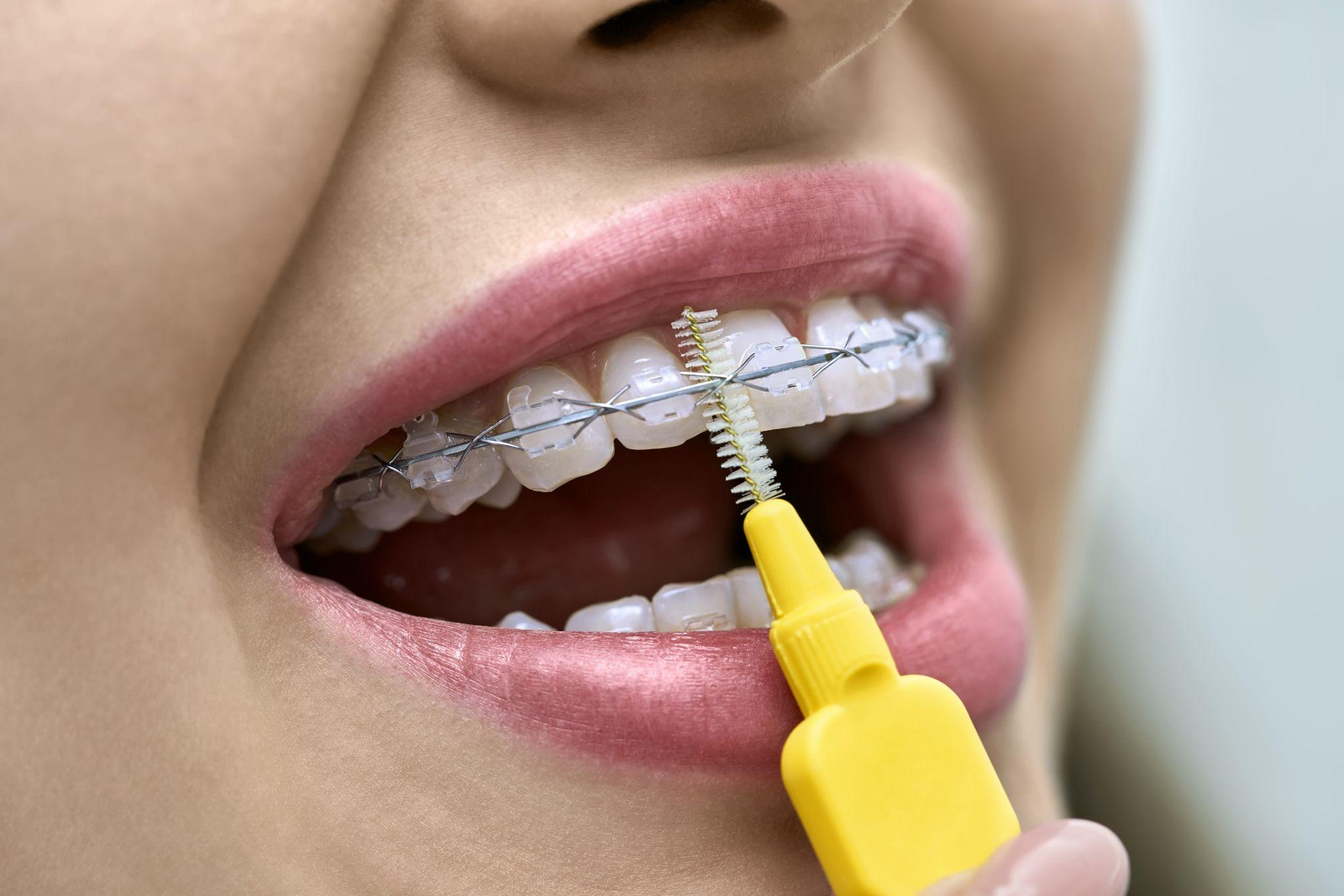 歯列矯正中の歯や矯正装置のお手入れ方法