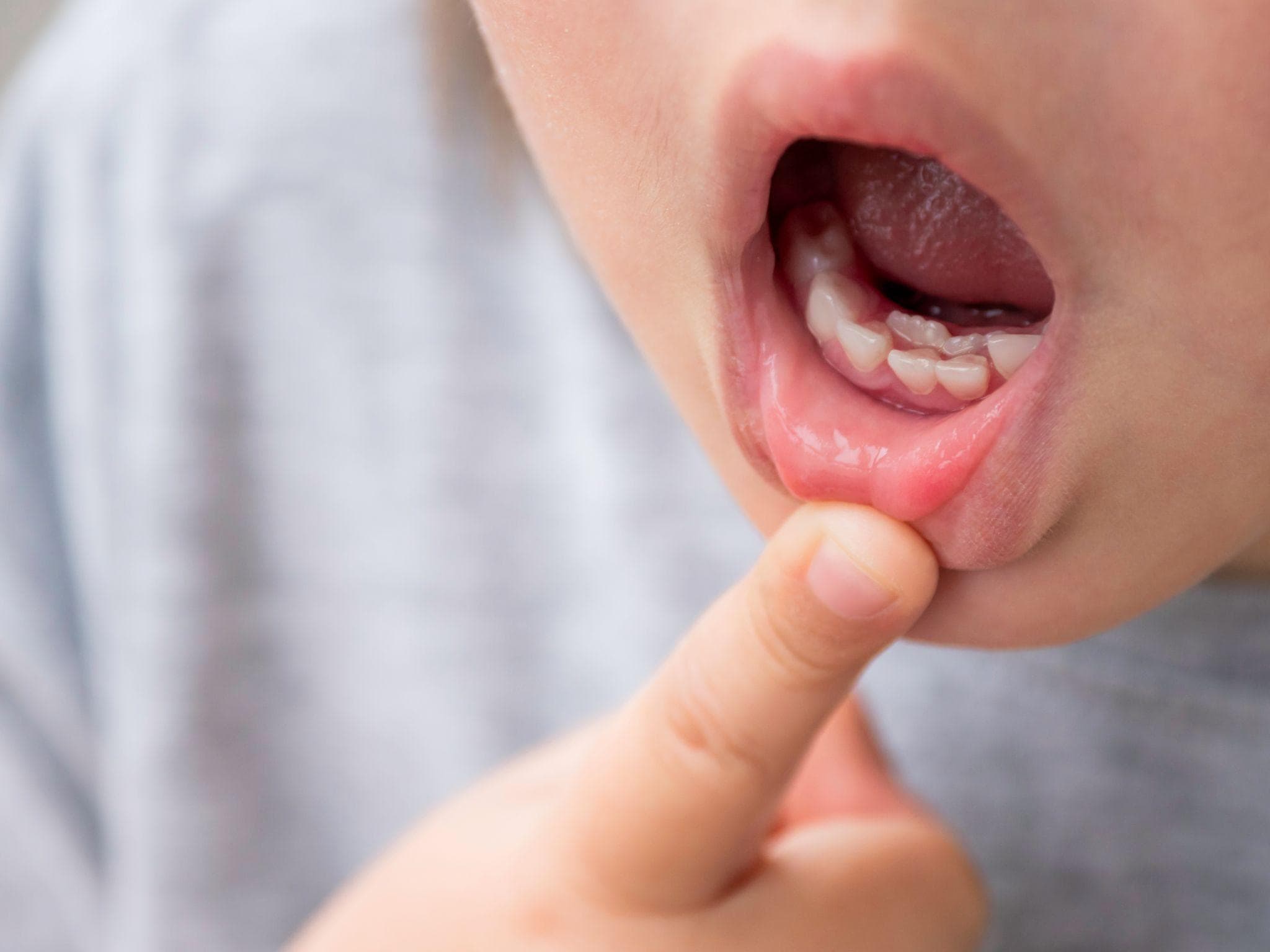 小児矯正で抜歯が必要になるのはどんなとき？