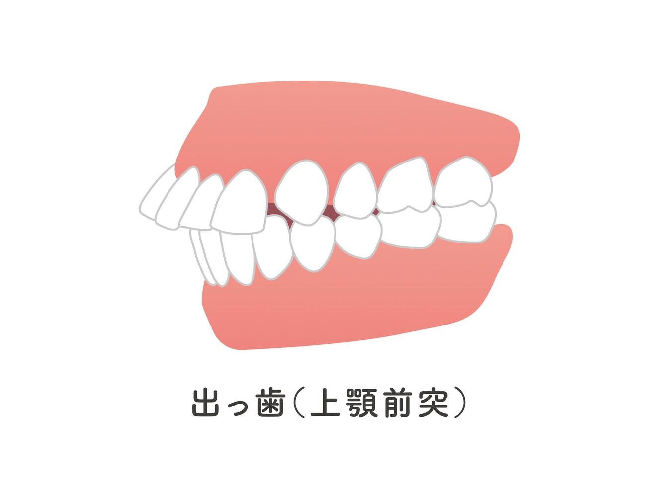 出っ歯（上顎前突）の程度を見分ける基準