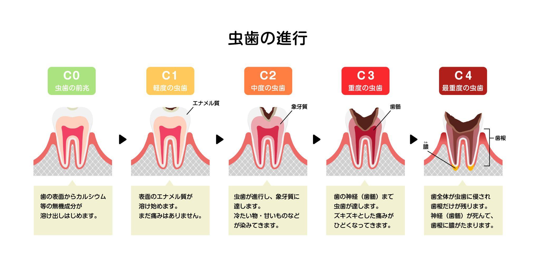 矯正中に虫歯が見つかったときの対処法