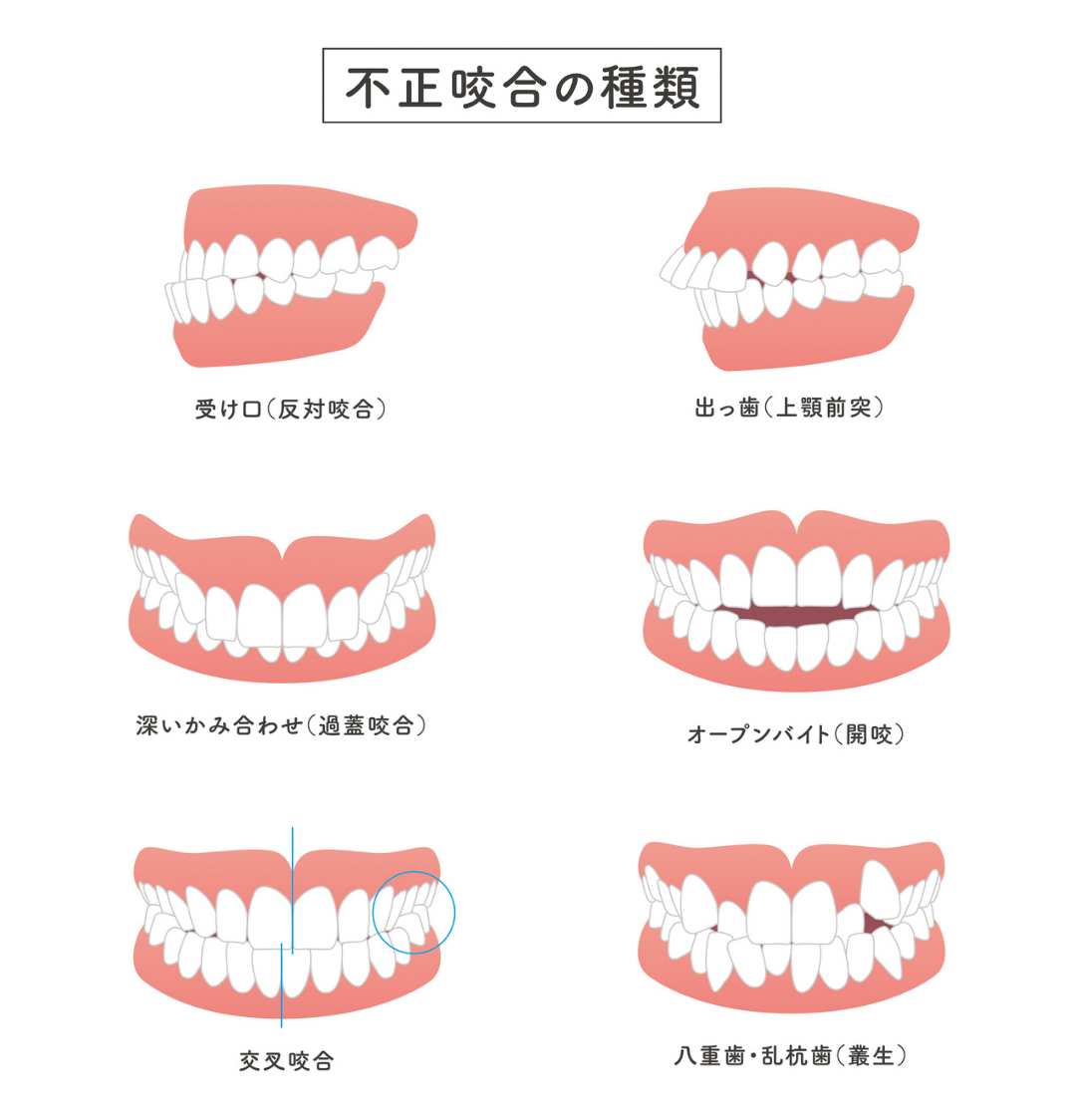 不正咬合の主なタイプ