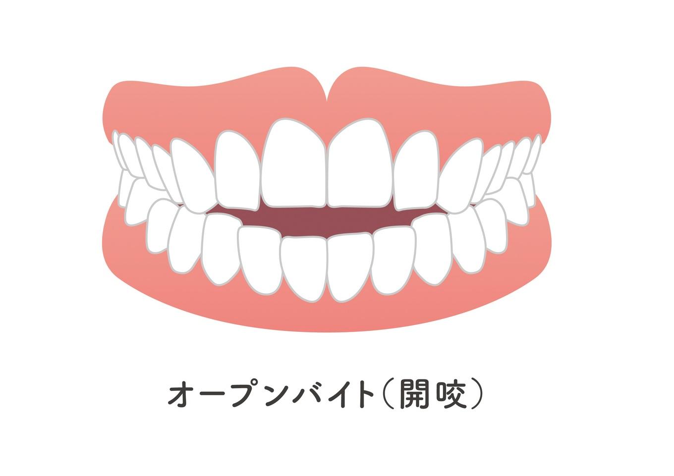 子供の開咬（オープンバイト）とは：前歯が閉じない噛み合わせ