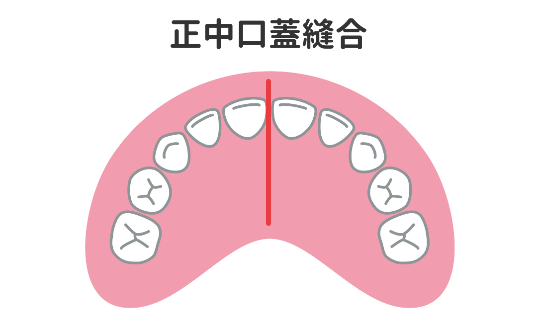 急速拡大装置との併用が多い理由